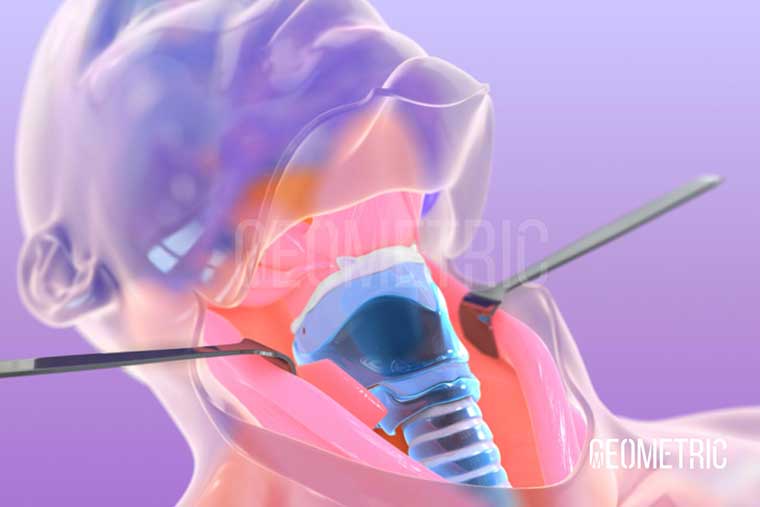 Laryngectomy medical animation