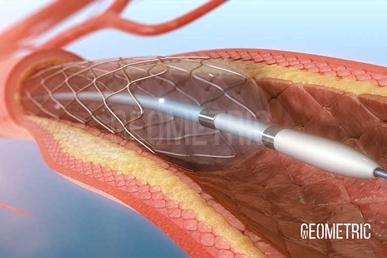 Angioplasty Procedure Illustration