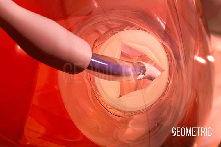 Aortic Valve Replacement Illustration