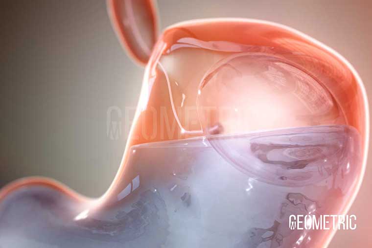 Weight Loss via Gastric Balloon