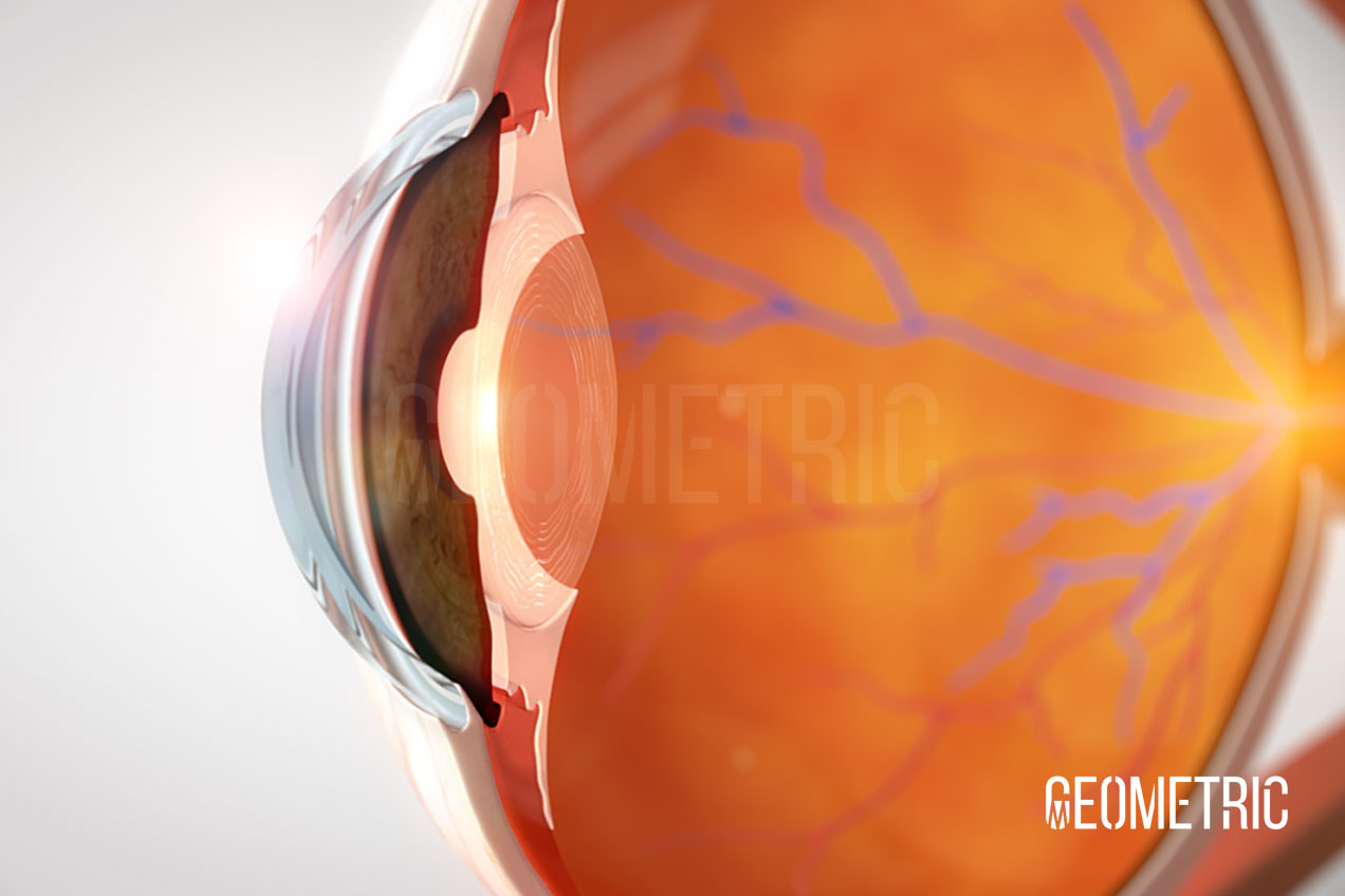 Crystalline Lens, illustrated by Geometric Medical