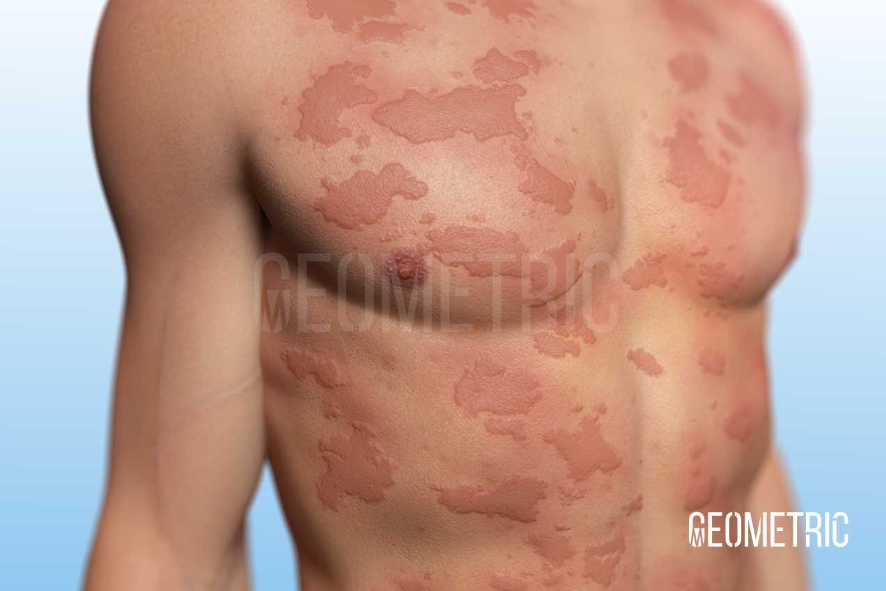 Skin disease, illustrated by Geometric Animation